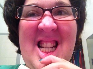 Invisalign, one week in. Aligners on.